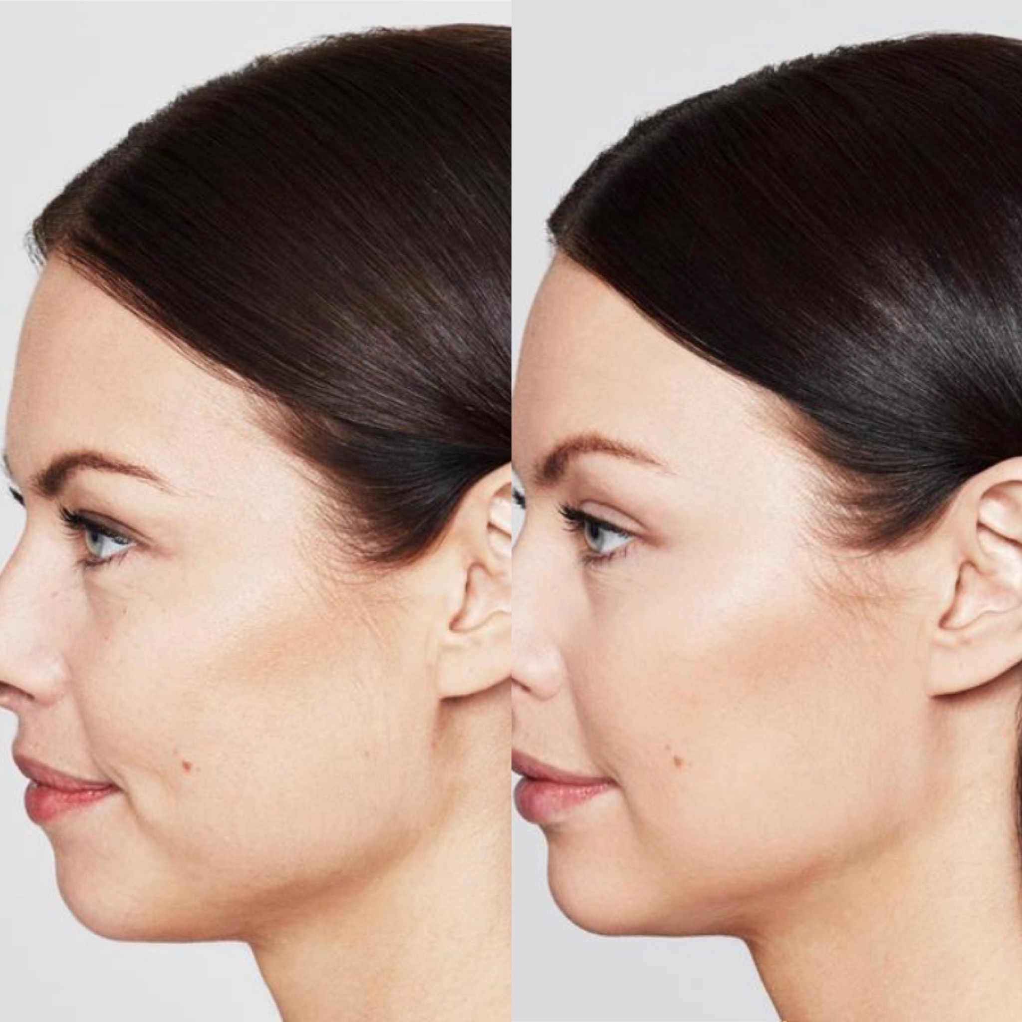 FACIALFILLERS5