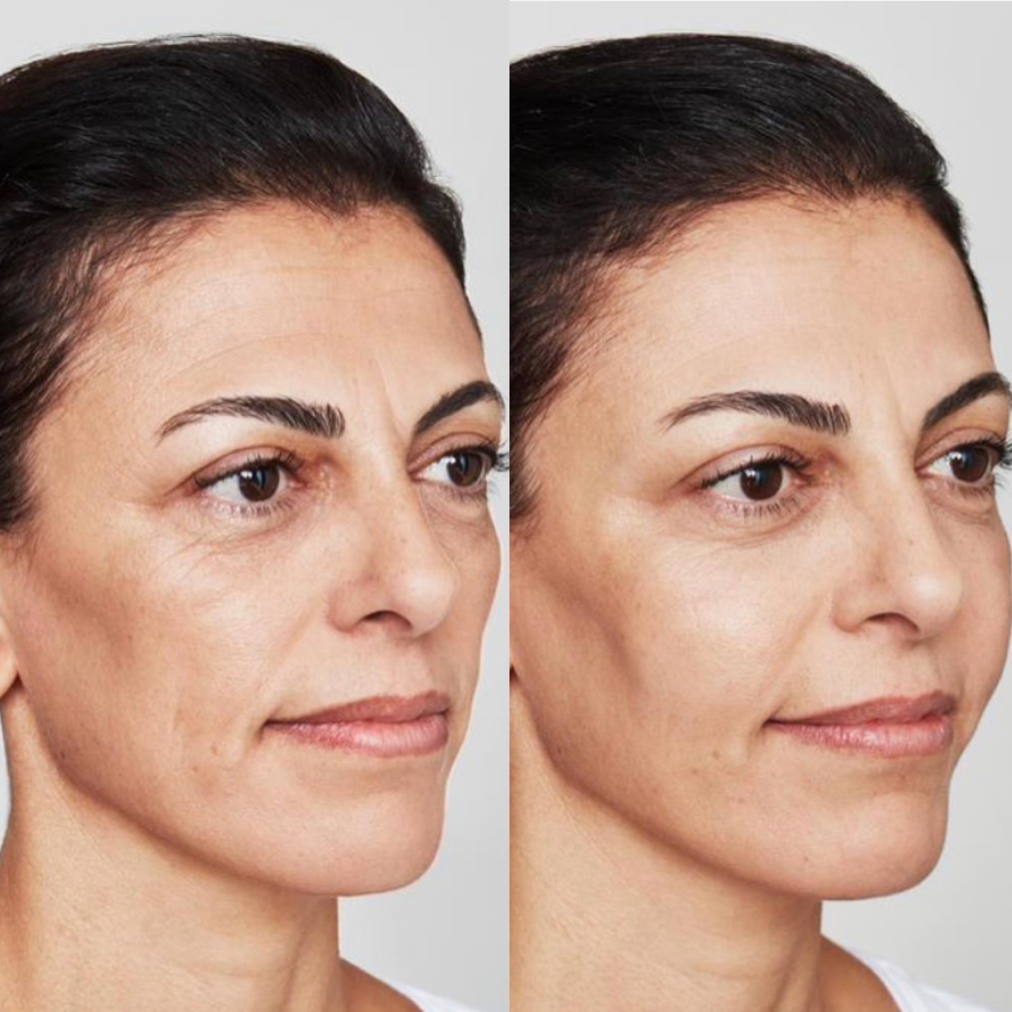 FACIALFILLERS6