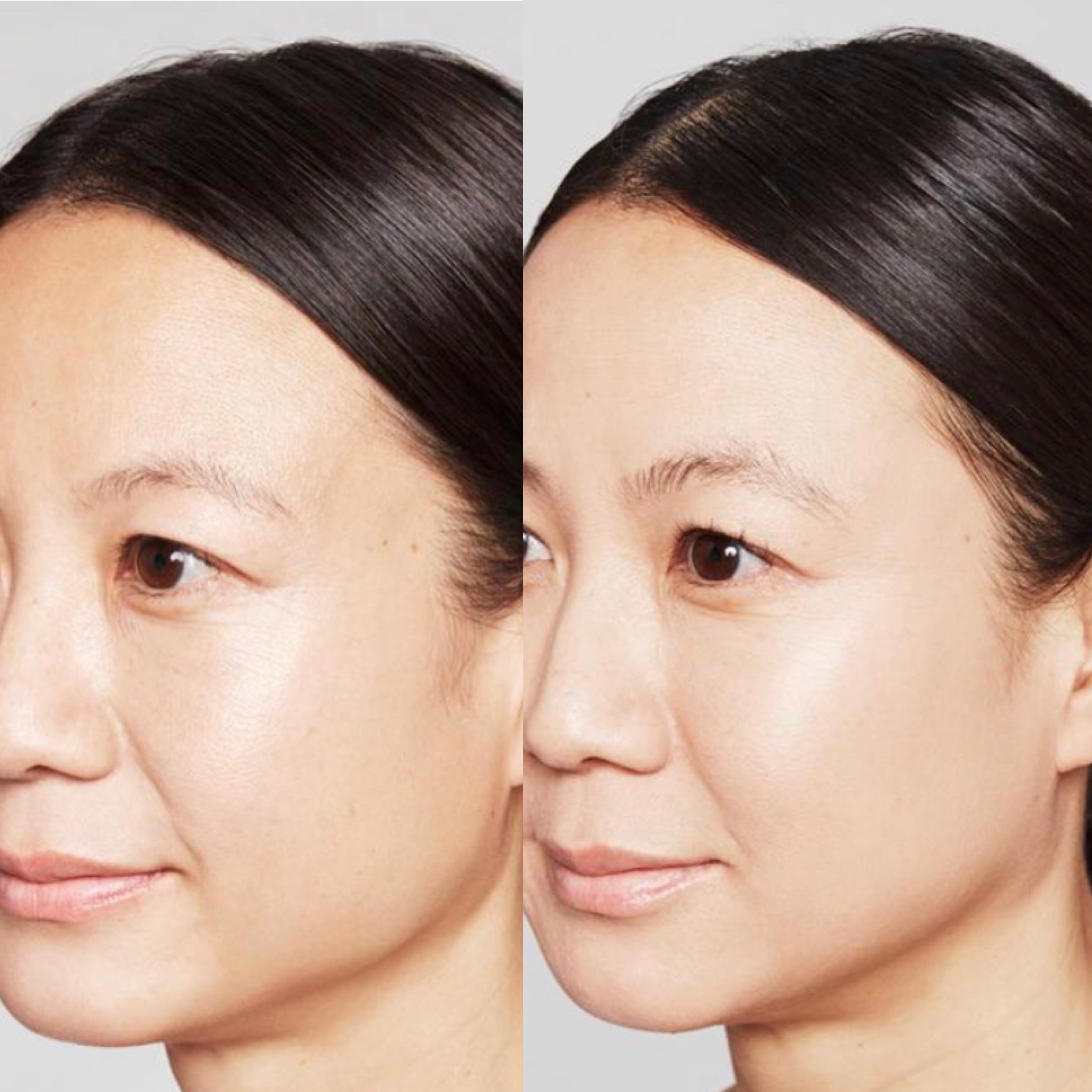 FACIALFILLERS7