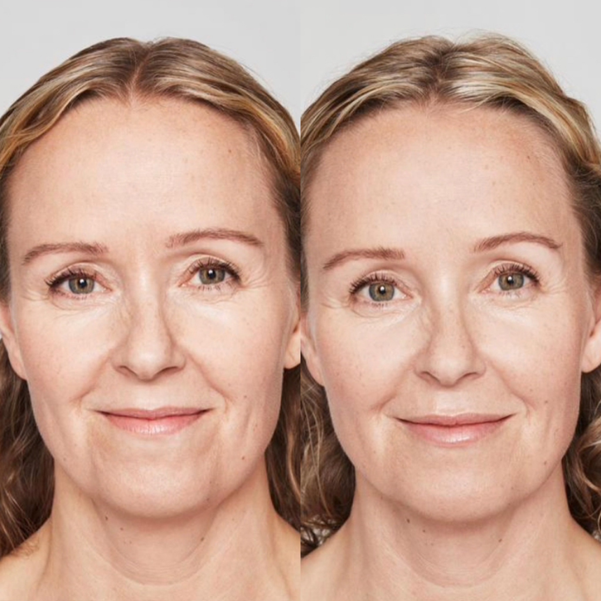 FACIALFILLERS8